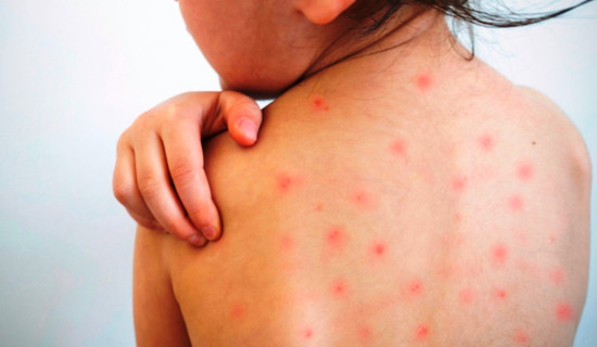 Measles outbreak in Dhorpatan under control