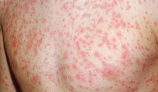 Two children found infected with measles in Shuklaphanta