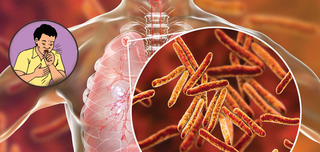 42 per cent TB patients still out of treatment in Nepal