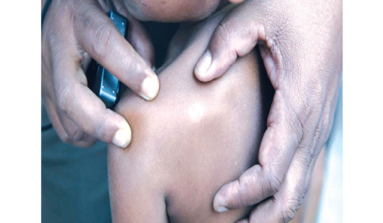 18 people diagnosed with leprosy in Chitwan